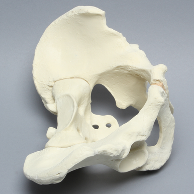 Sawbones Pelvis masculina con acetábulo artrósico