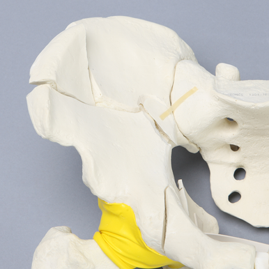 Sawbones Pelvis masculina con fractura de ambas columnas y fémur encapsulado