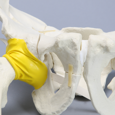 Sawbones Pelvis masculina con fractura de ambas columnas y fémur encapsulado
