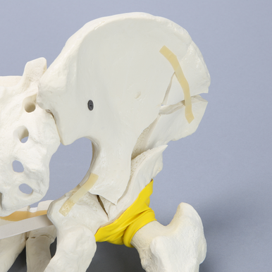 Sawbones Pelvis masculina con fractura de ambas columnas y fémur encapsulado