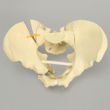 Sawbones Pelvis masculina con fracturas de ramas y sacroilíaca