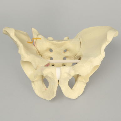 Sawbones Pelvis masculina con fracturas de ramas y sacroilíaca