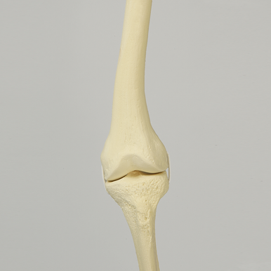 Sawbones Rodilla con deformidad en valgo de 10° del fémur distal