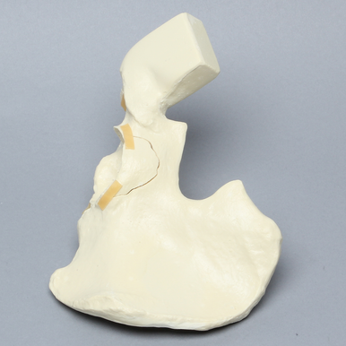 Sawbones Hemipelvis con fracturas de pared acetabular derecha