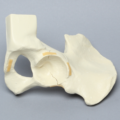 Sawbones Hemipelvis con fracturas de pared acetabular derecha