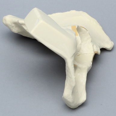 Sawbones Hemipelvis con fracturas de pared acetabular derecha