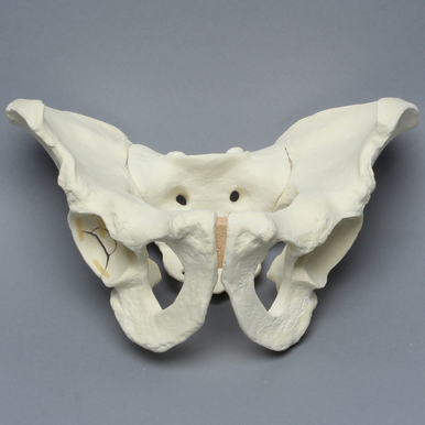 Sawbones Pelvis masculina con fractura de pared posterior