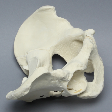 Sawbones Pelvis masculina con fractura de pared posterior