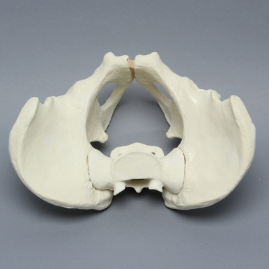 Sawbones Pelvis masculina con fractura de pared posterior